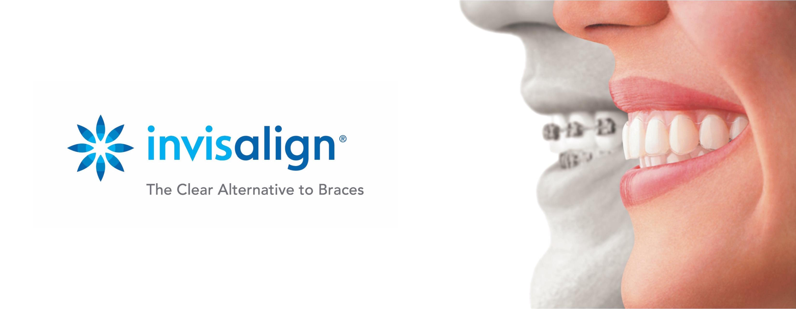 Invisalign, Clear Aligners, North Vancouver